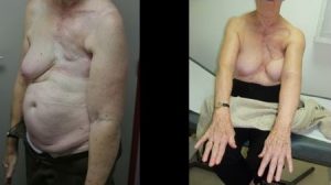 Outcome of an anlarged DIEP on a patient who suffered lymphoedema for 20 years after a mastectomy