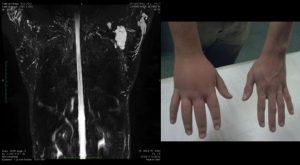 Hypertrophic congenital lymphedema of the arm