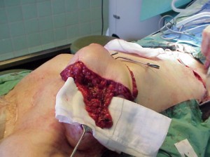 Modified DIEP transplant with lymph nodes