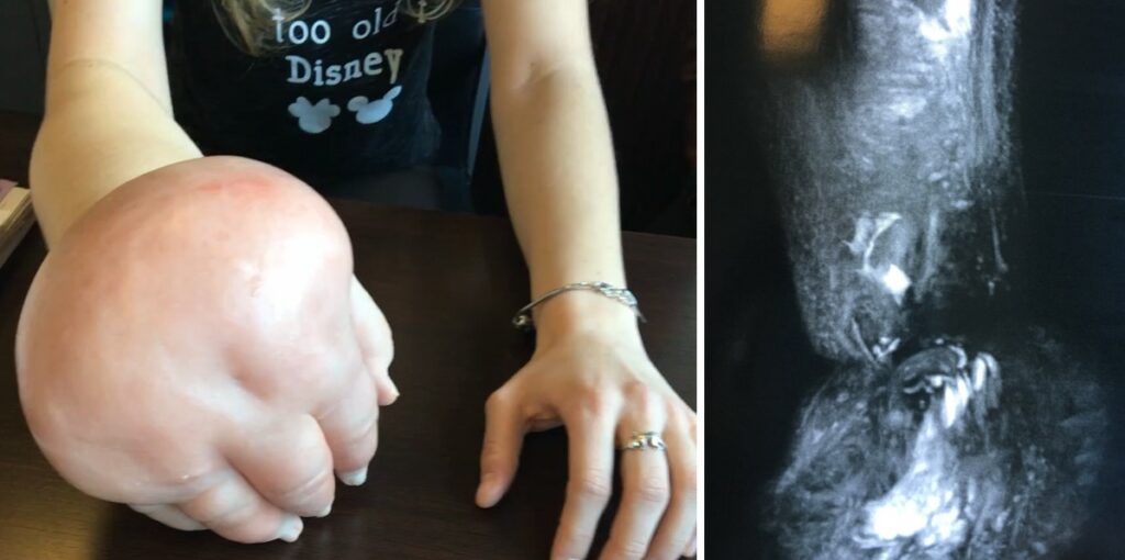 Preop : no myphatic vessesl