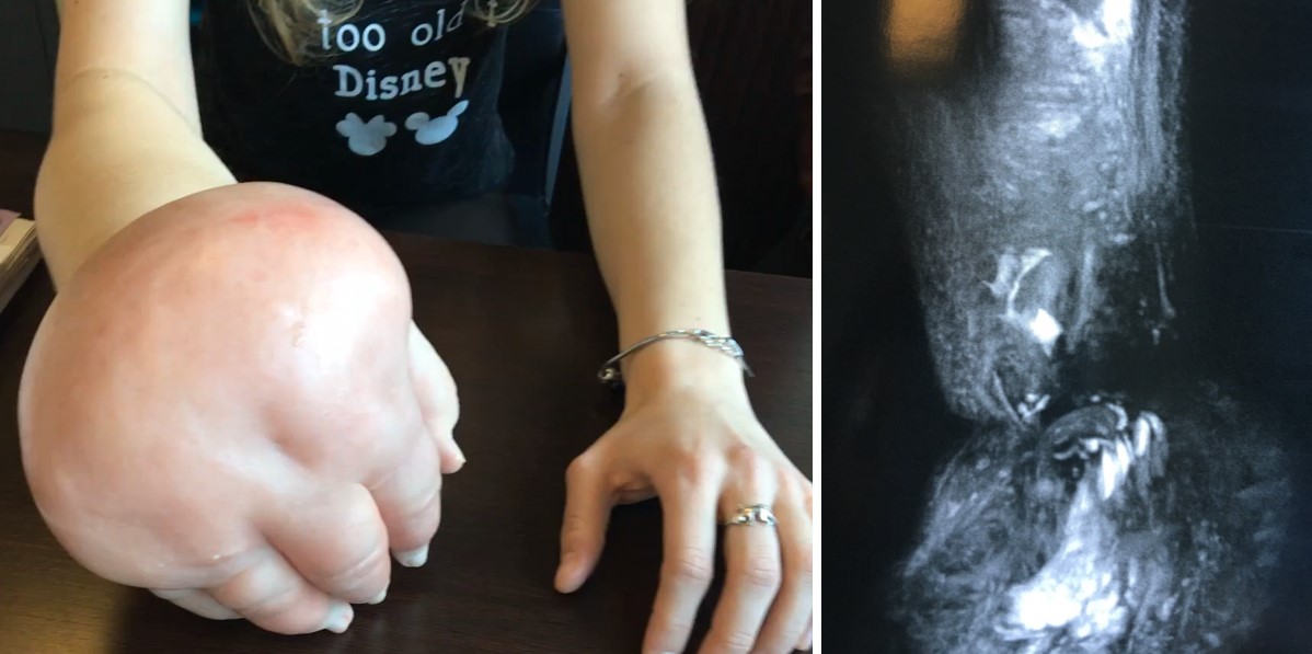 Preop : no myphatic vessesl